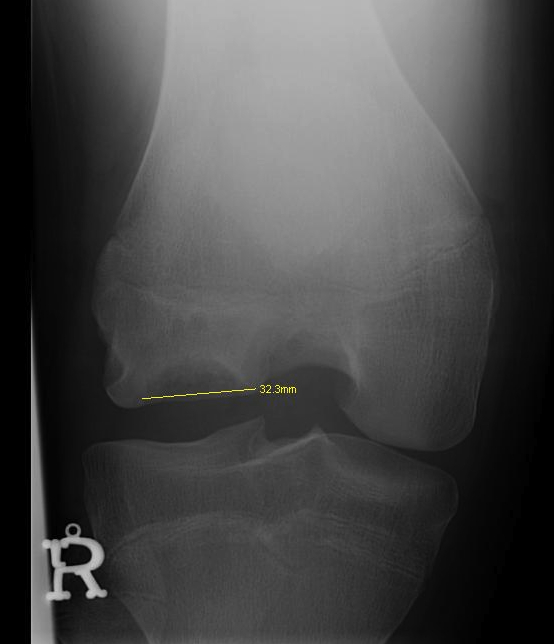 Femoral OCD 2